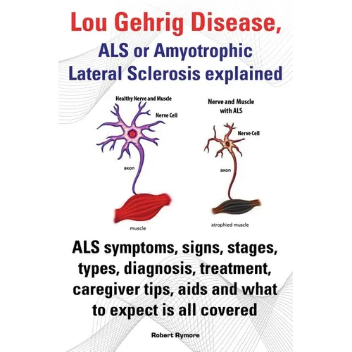 Lou Gehrig Disease, ALS or Amyotrophic Lateral Sclerosis Explained. ALS Symptoms, Signs, Stages, Types, Diagnosis, Treatment, Caregiver Tips, AIDS and